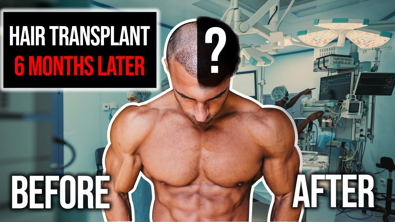 Hair Transplant Results After 6 Months | Before & After