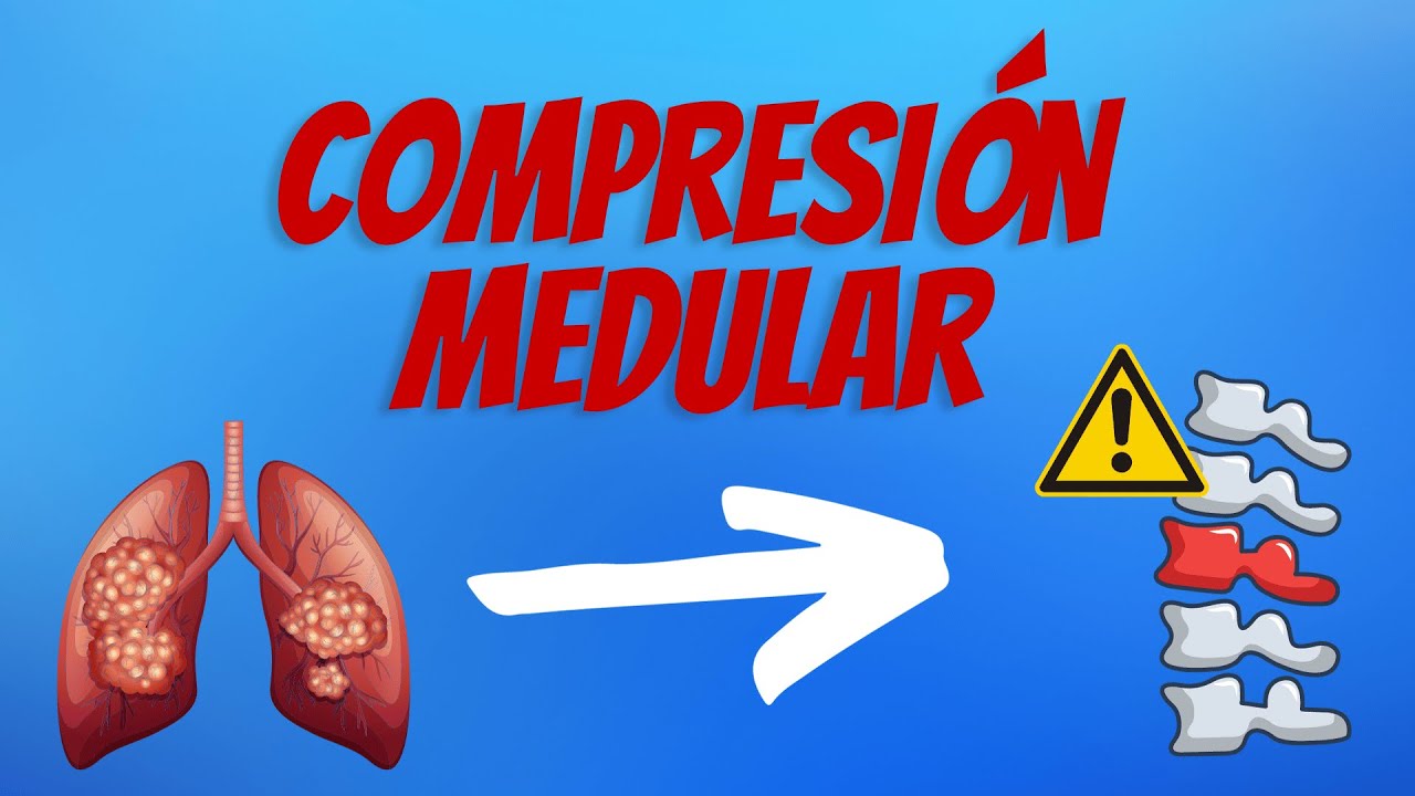 S&iacute;ndrome Compresi&oacute;n Medular Explicado Claramente