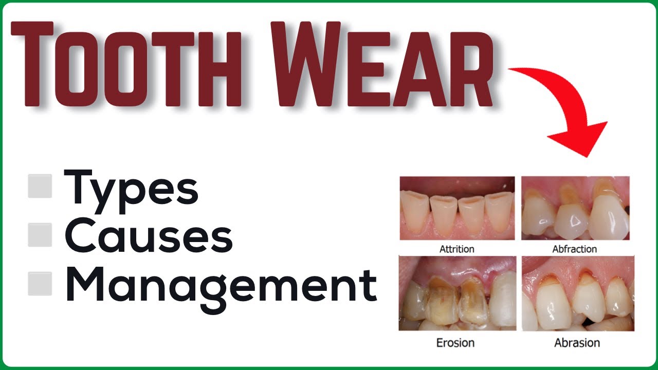 TOOTH WEAR - Types, Causes & Management