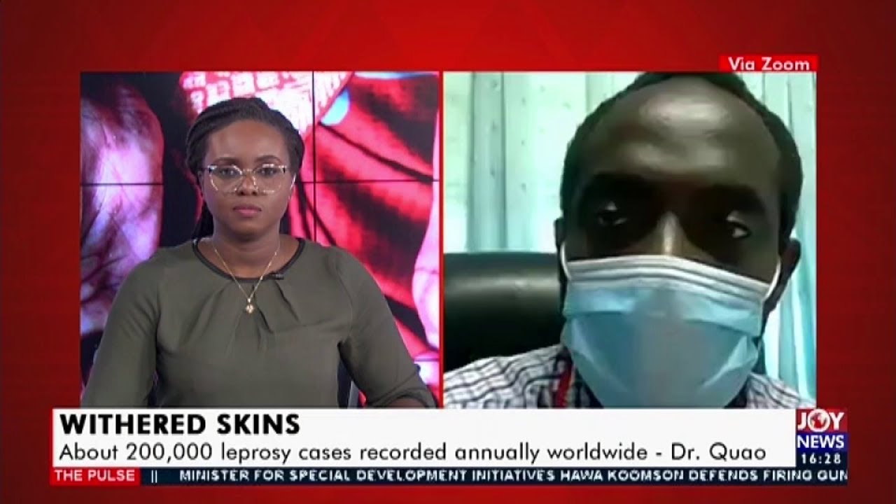 Withered Skins: About 200,000 leprosy cases recorded annually worldwide &ndash; Dr. Quao (21-7-20)