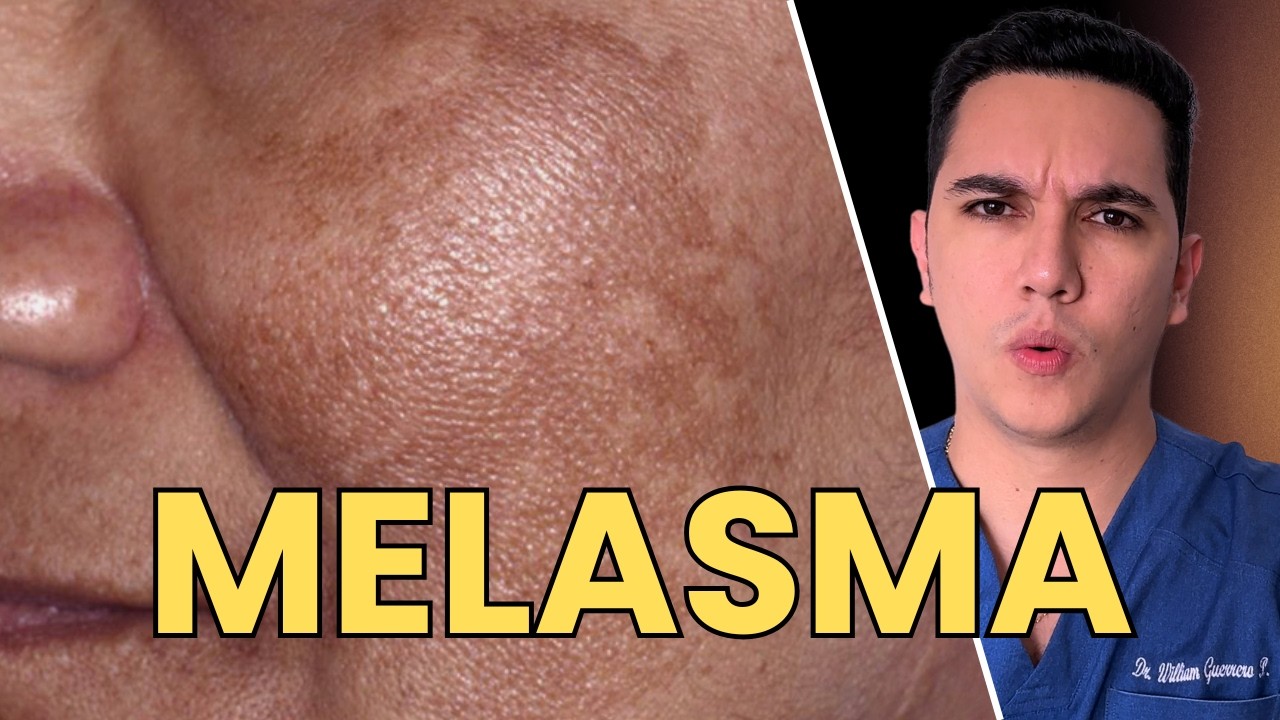 Melasma la mancha en la cara que no se borra fácil | Dr. William Guerrero