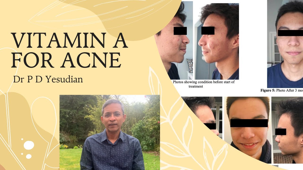 Witamina A na trądzik &ndash; alternatywa dla Accutane