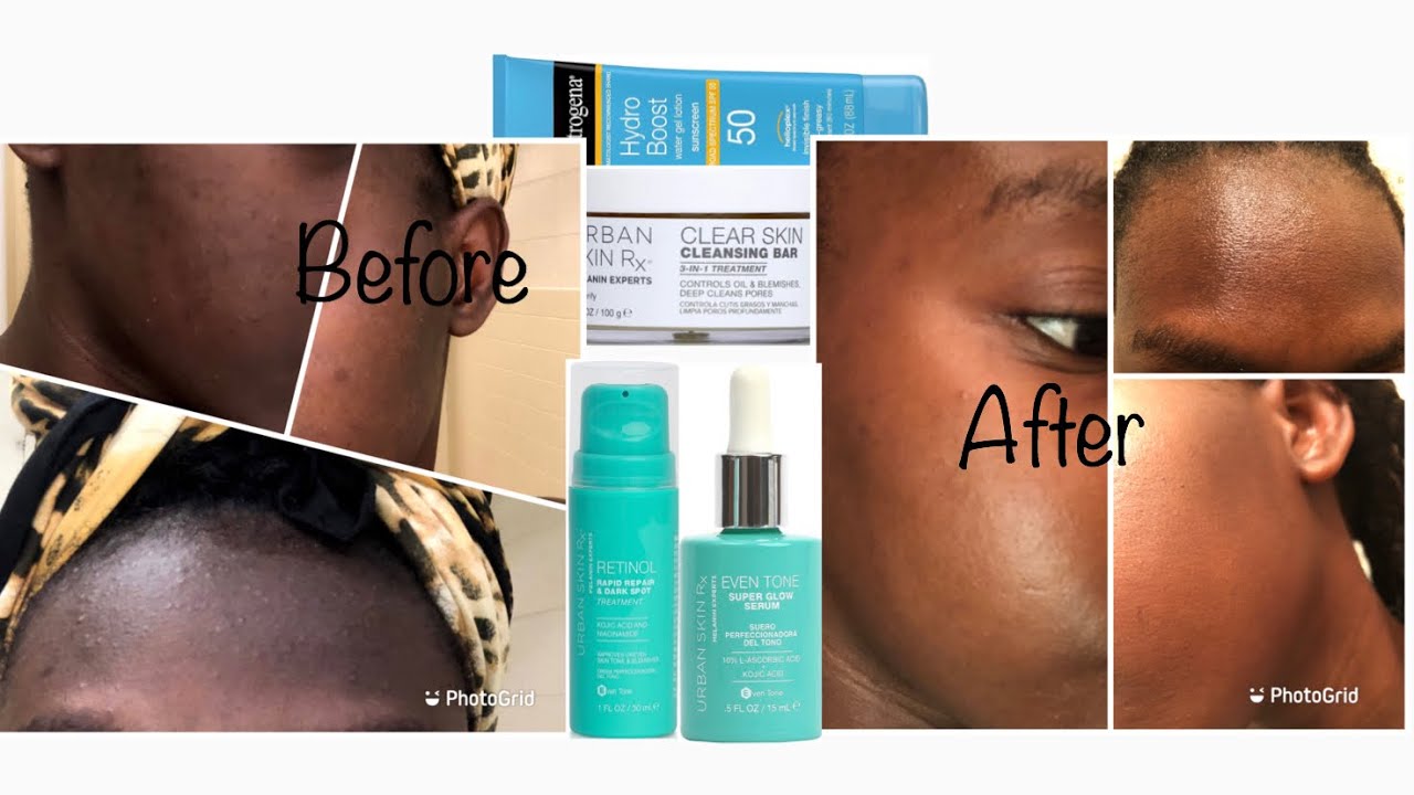 How I cleared my skin | Urban Skin Rx | Nicka M  