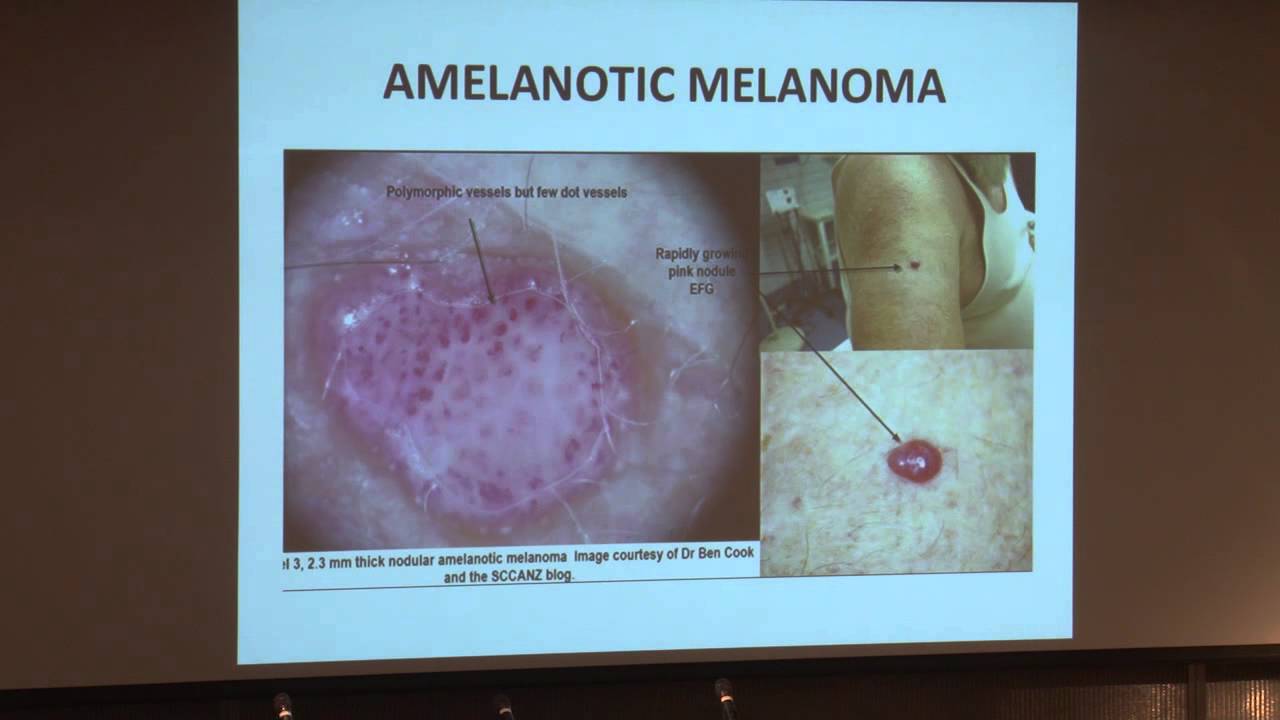 Not Your Typical Melanoma: Clinical Clues and Pitfalls