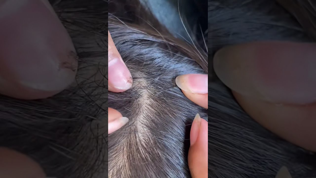 (Part 32) Lice Removal & Treatment Satisfying Lice Popping #lice #liceremoval #satisfying