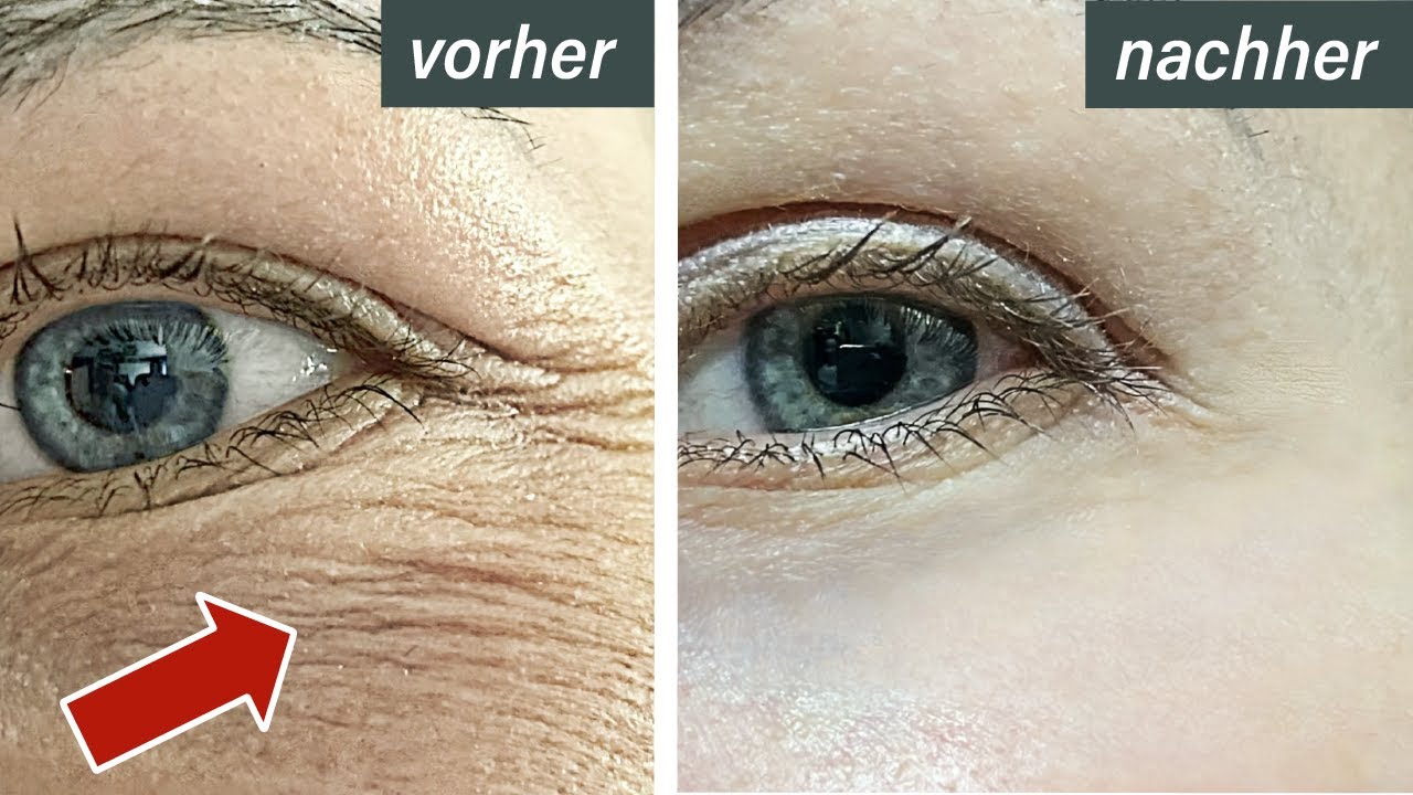 👀 Krasses Ergebnis❗In 1 Woche Augenfalten loswerden