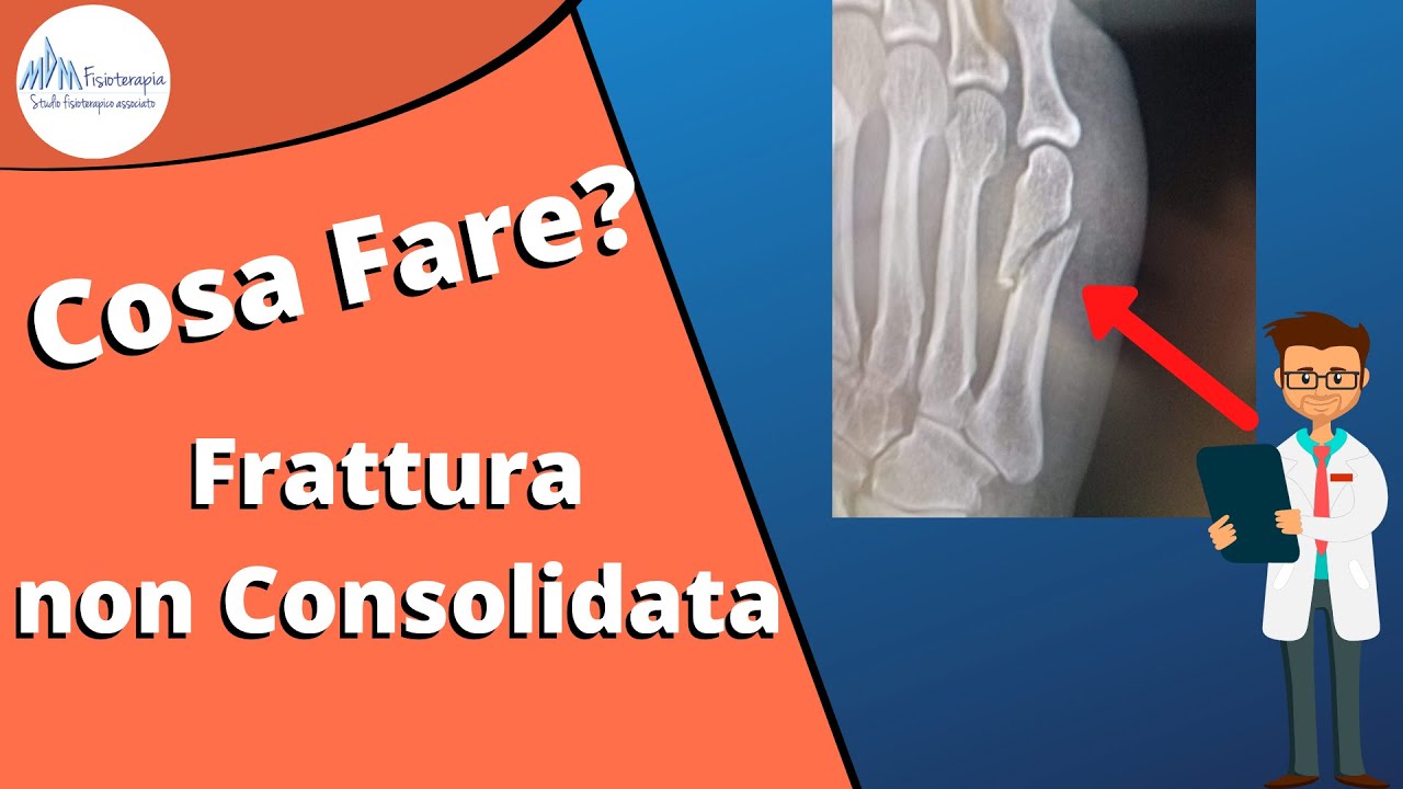Frattura non consolidata | Il ritardo di consolidazione e Cosa Fare per Guarire