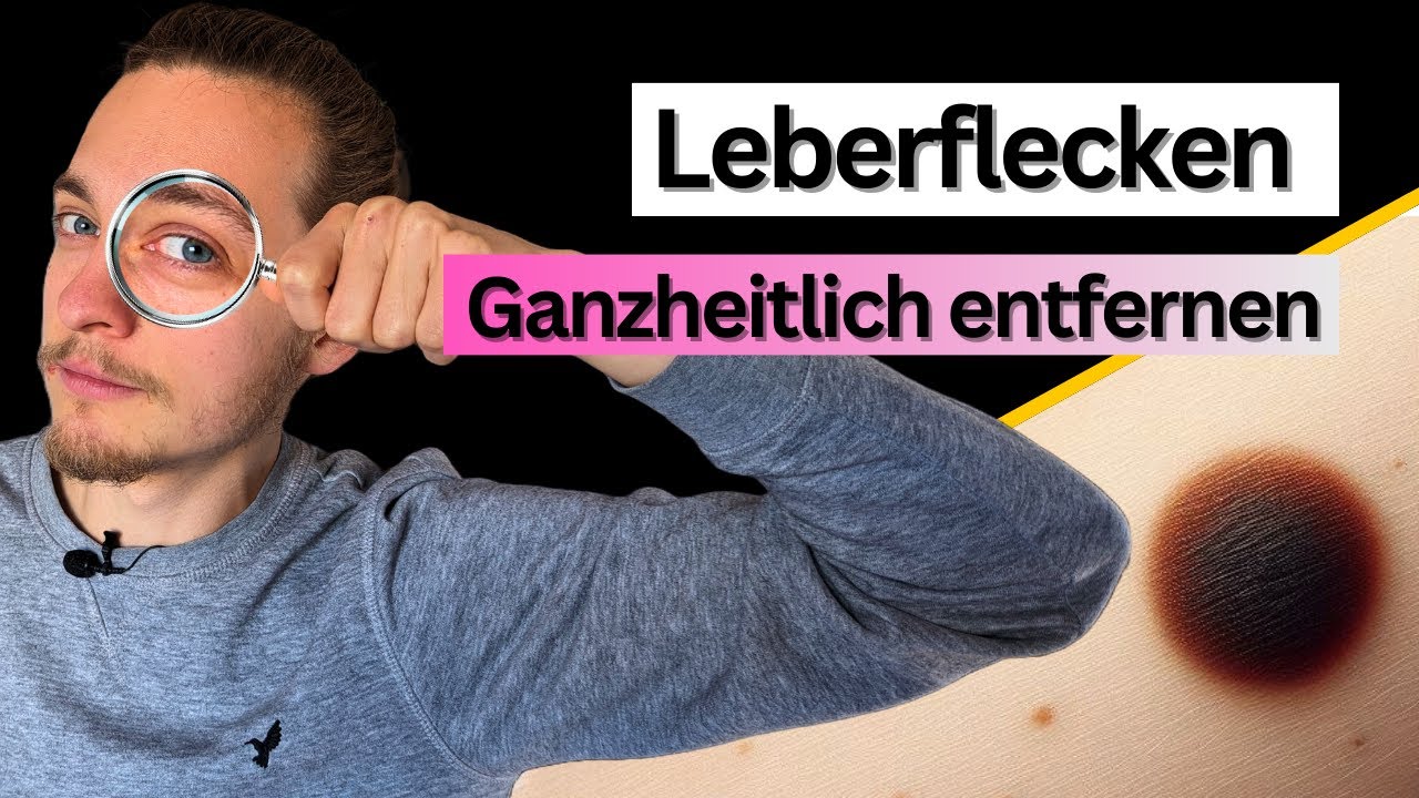 Wie du Leberflecken NATÜRLICH entfernst