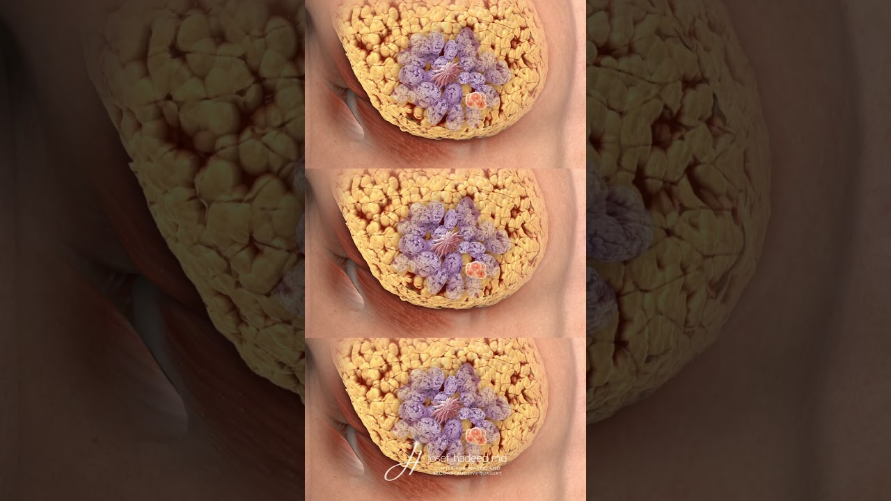 Diagnosing Gynecomastia