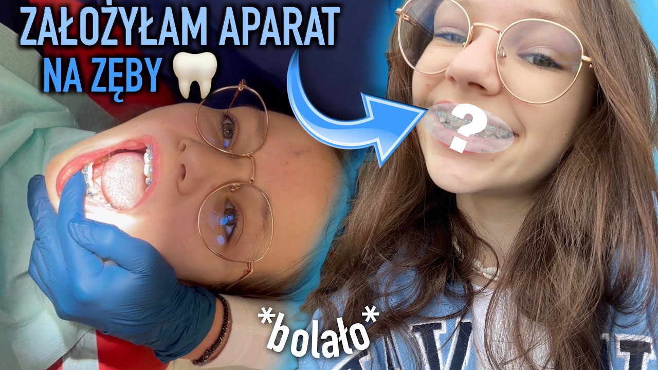 ZAKŁADAM APARAT NA ZĘBY! *bolało?* 🦷😲