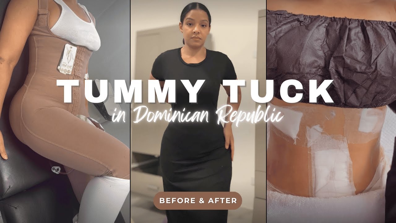Tummy Tuck in the Dominican Republic: My Real Experience | Before & After Transformation