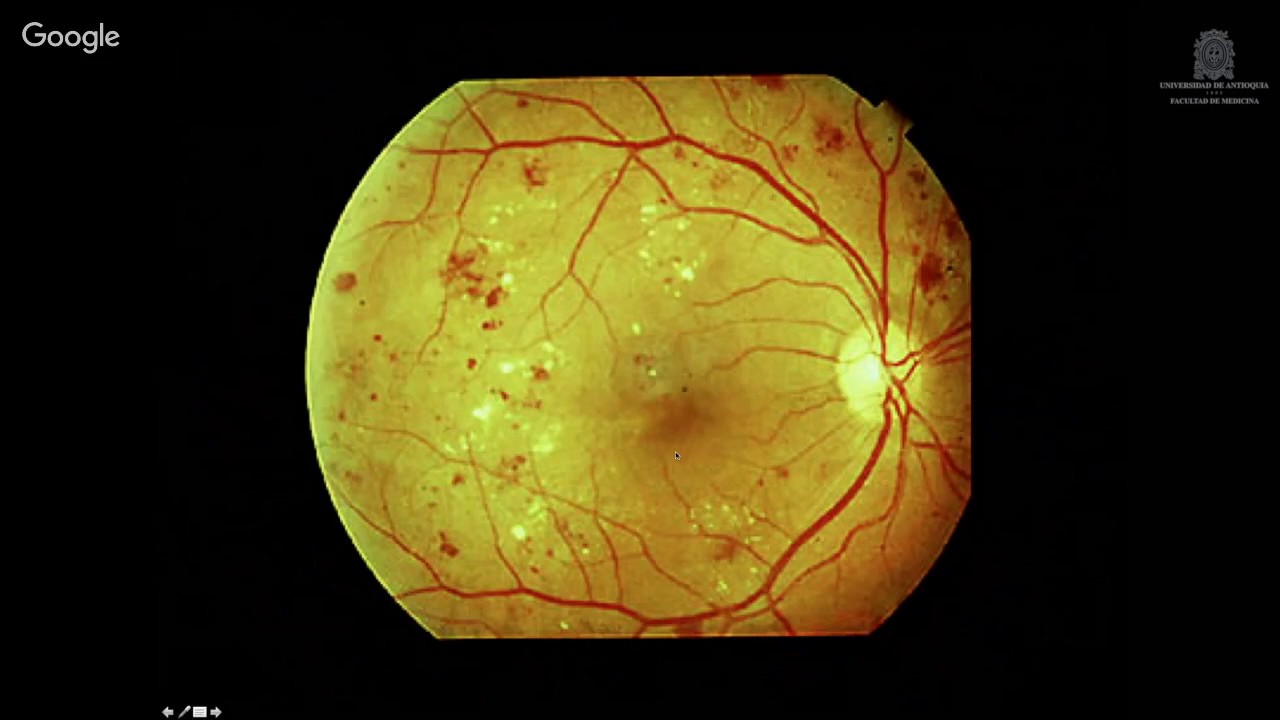 Complicaciones cronicas microvasculares de la diabetes mellitus