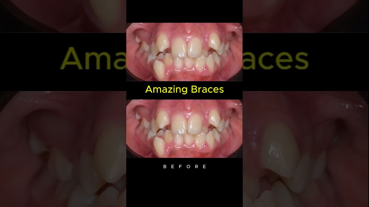 Amazing braces. Fix super crooked teeth #dentist #braces #orthodontist