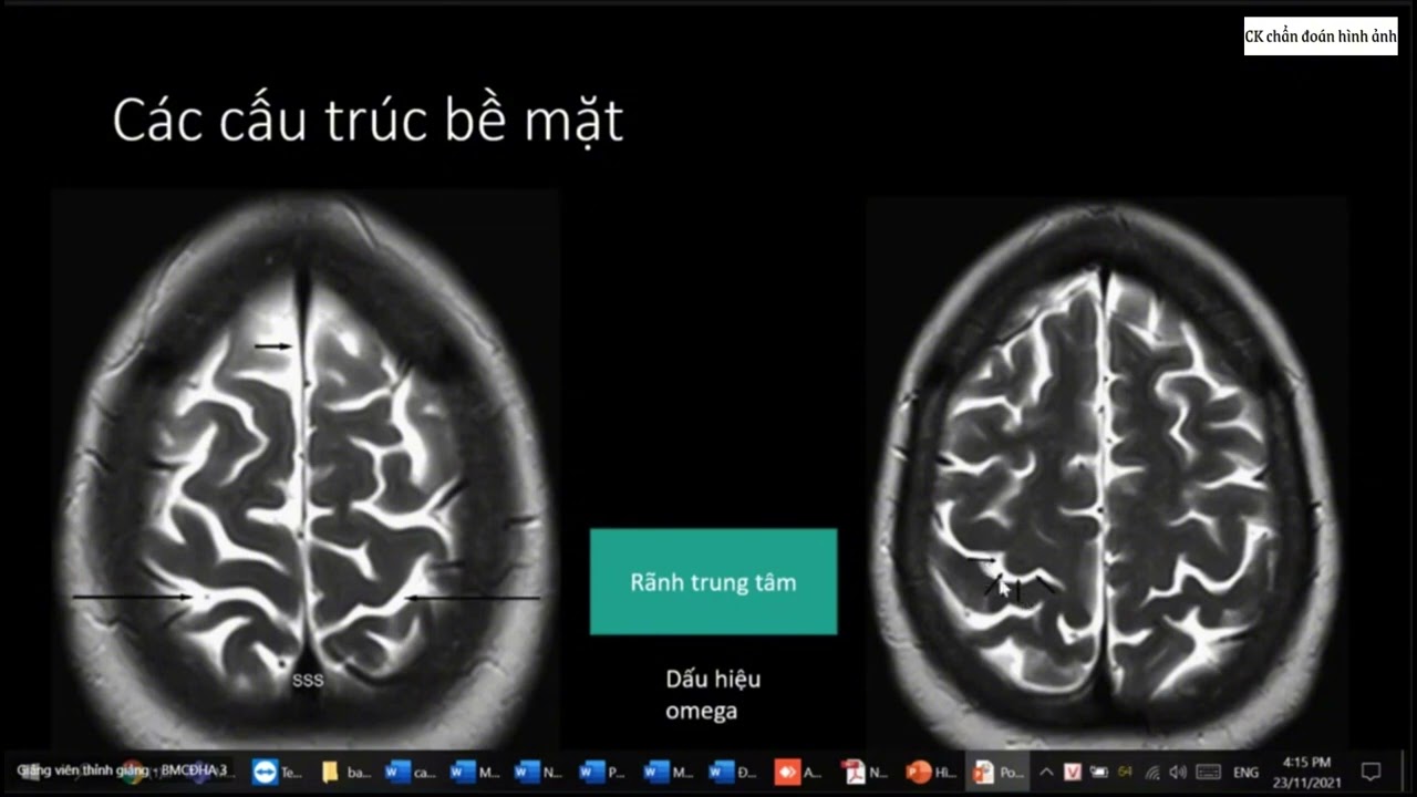 Hình ảnh CT - MRI sọ não bình thường và các biến thể