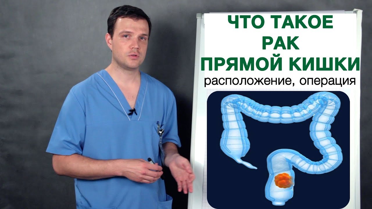 Что такое рак прямой кишки. Опухоль, образования в прямой кишке. Врач-онколог Владимир Лядов