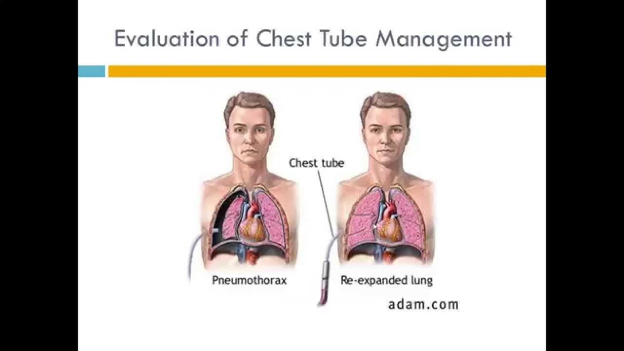 Nursing Management of Clients with Chest Tubes
