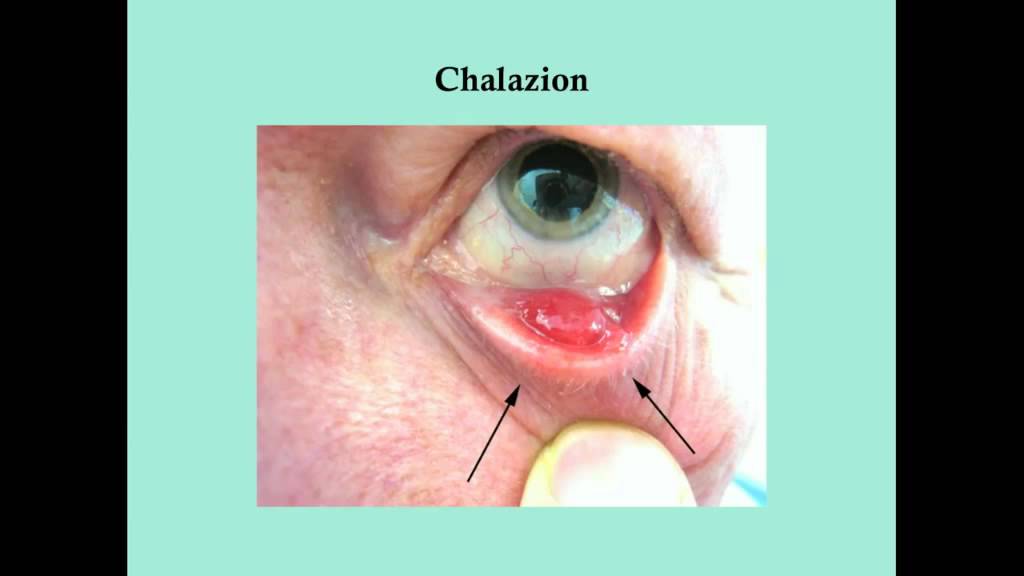 Disorders of the Eye Lid - CRASH! Medical Review Series