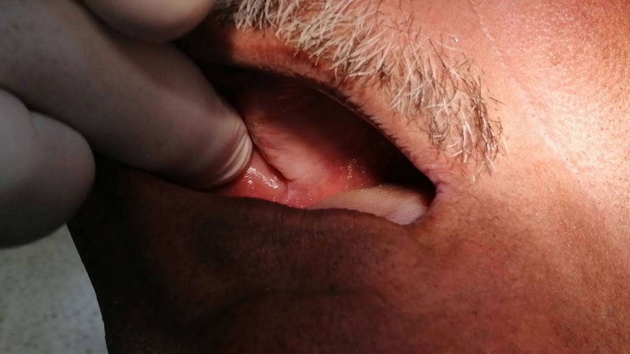 Visit 1: Residual ridge is different left from right. Reasons and how to check