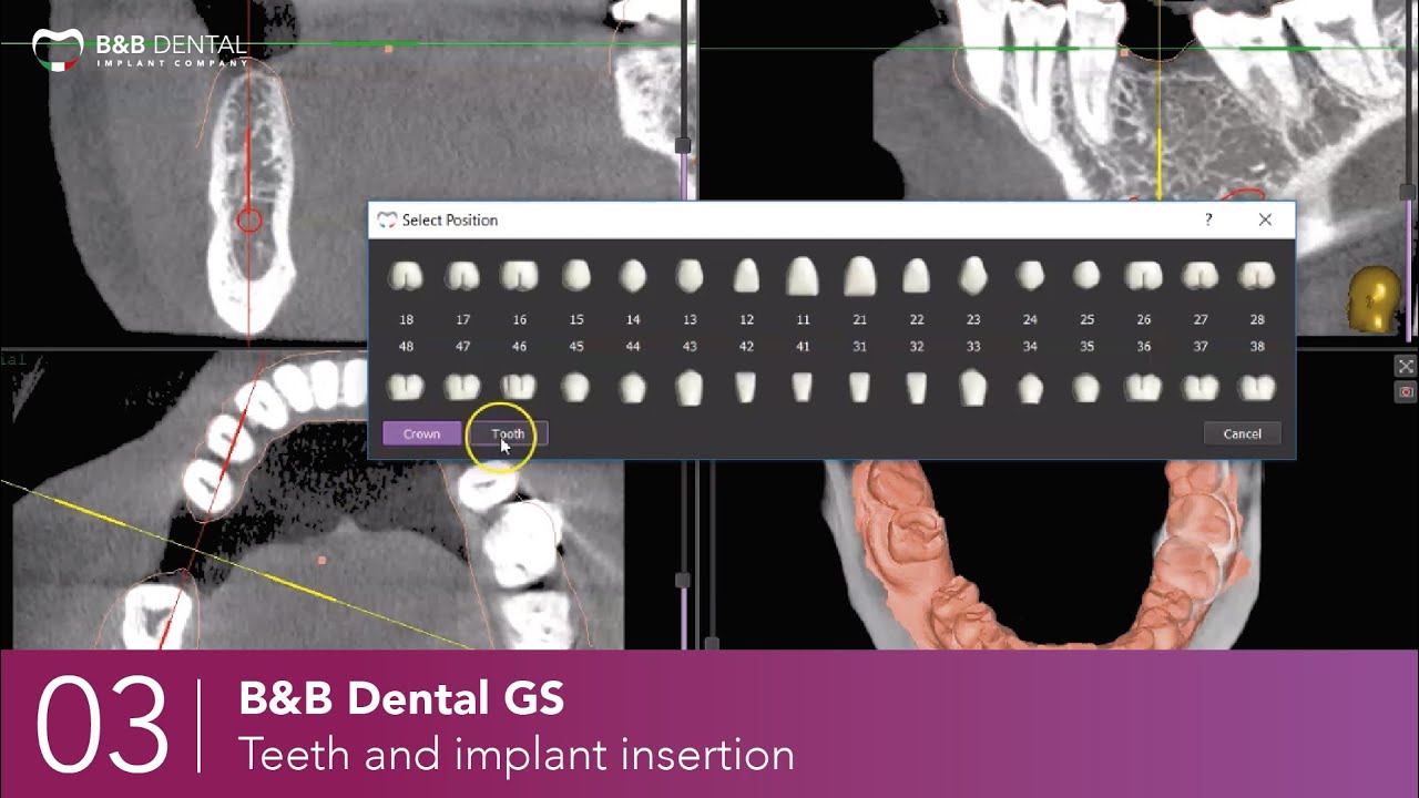 B&B Dental GS -  03 - Teeth and implant insertion
