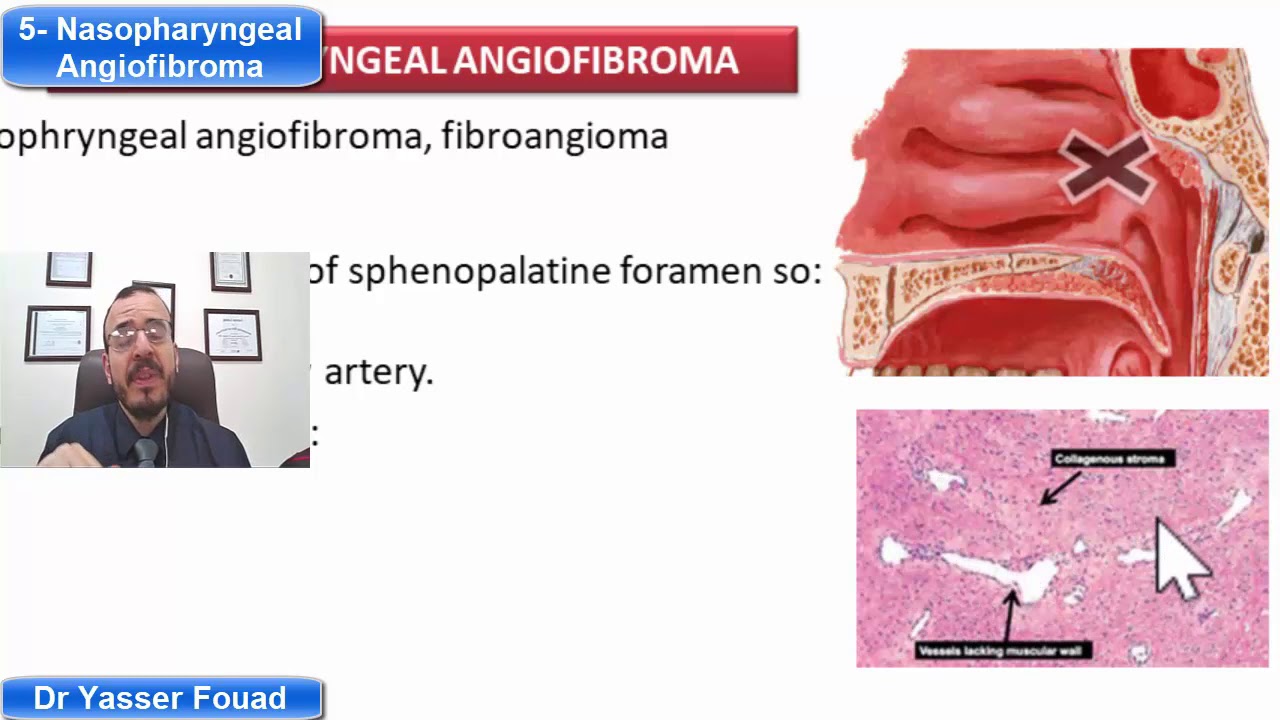 5- Nasopharyngeal Angiofibroma