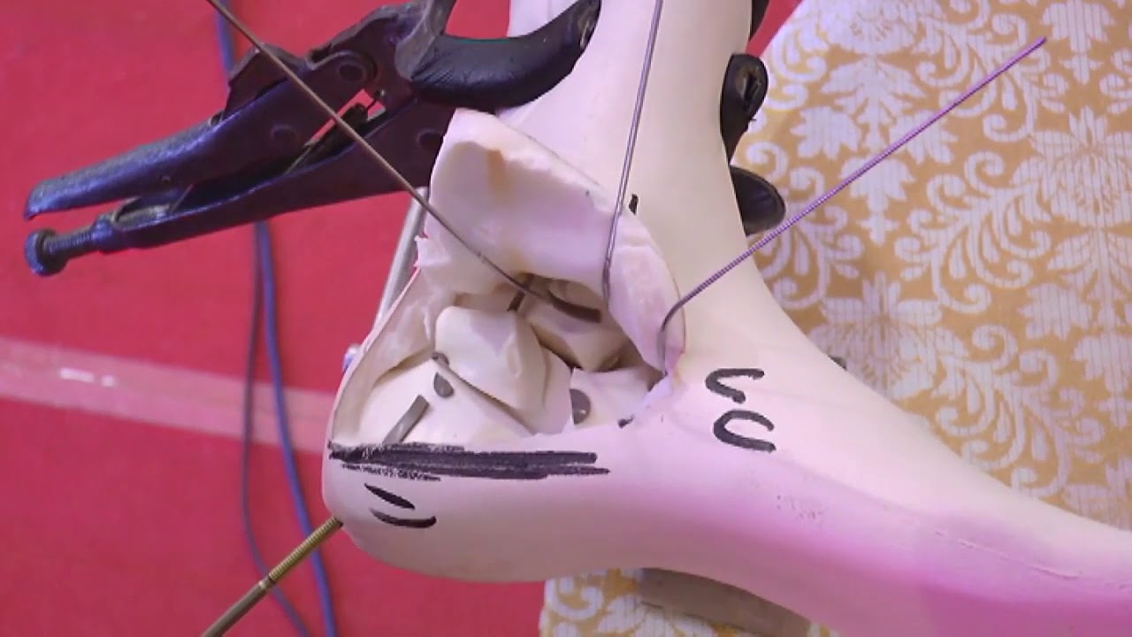 Bone Model Calcaneum fracture fixation, Dr  Balvinder Rana, Olwa Foot & Ankle Course