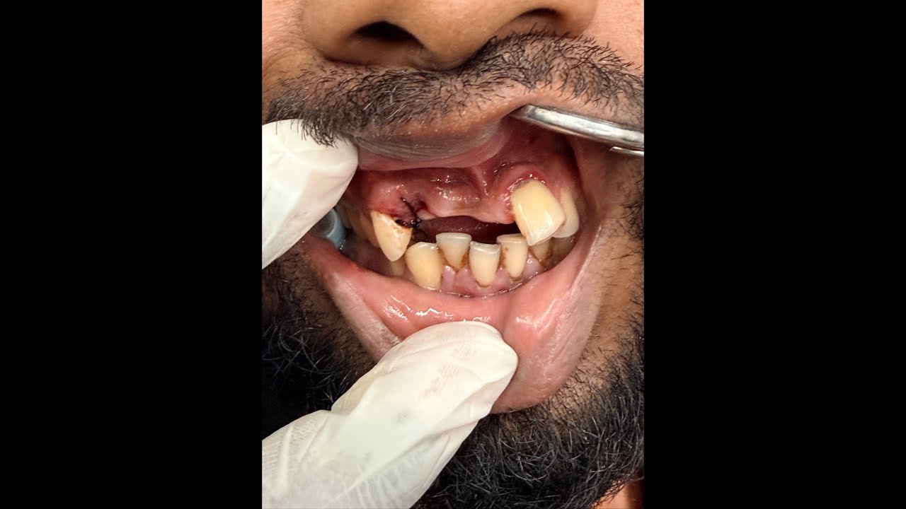 আঁকাবাঁকা উঁচু-নিচু এবং পরে যাওয়া দাঁতের চিকিৎসা মাত্র তিন দিনে।