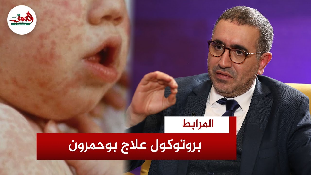 مسؤول بوزارة الصحة: بوحمرون يصيب الإنسان مرة واحدة وهذه طريقة علاجه