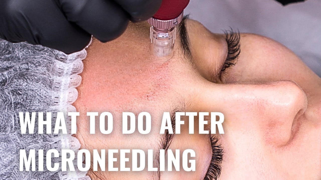 Microneedling Aftercare - Do's and Don'ts for Best Results