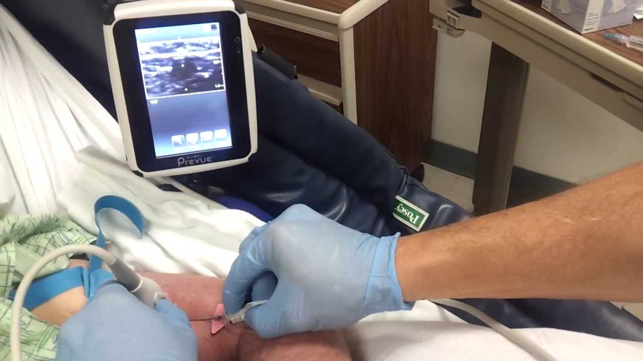 PIV insertion with Preview ultrasound