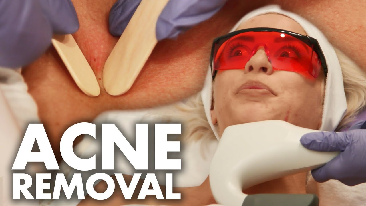 Treating Acne & Blackheads w/ NURSE JAMIE (Beauty Trippin)