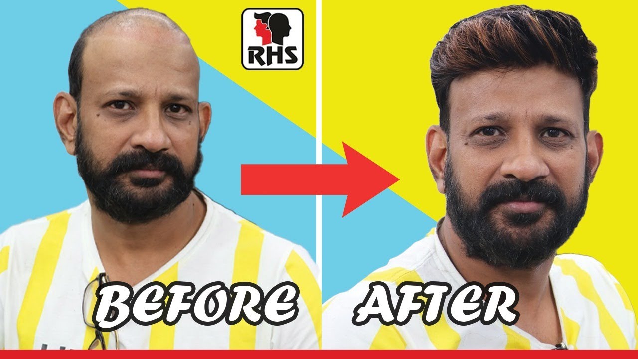 Natural Hair Transformation | Hair Wigs for Men | Hair Patches for Men | Rizy hair Solution
