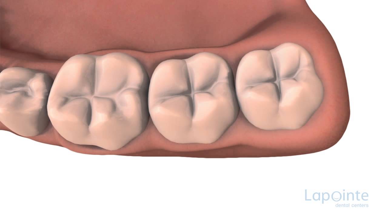 Pit and fissure sealants - Lapointe dental centres