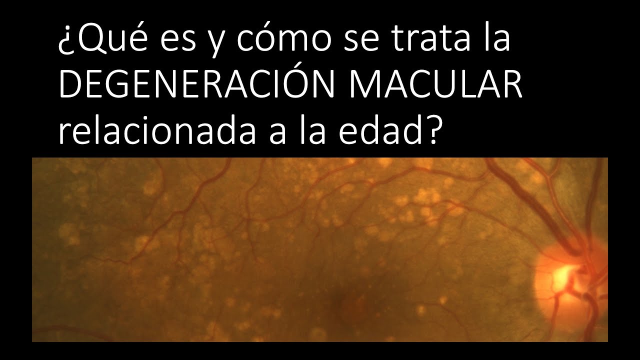 ¿Qué es y cómo se trata la degeneración macular relacionada a la edad?