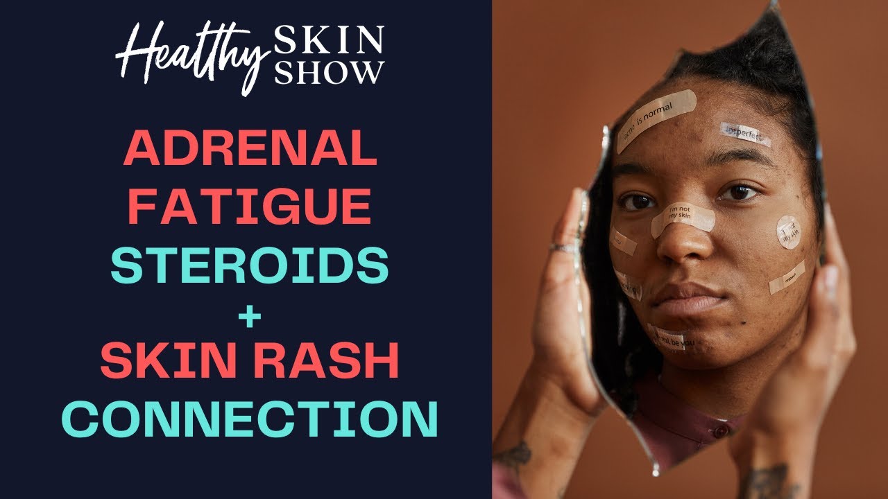 Adrenal Fatigue, Steroids + Skin Rashes: What's The Connection? | Dr. Izabella Wentz, PharmD