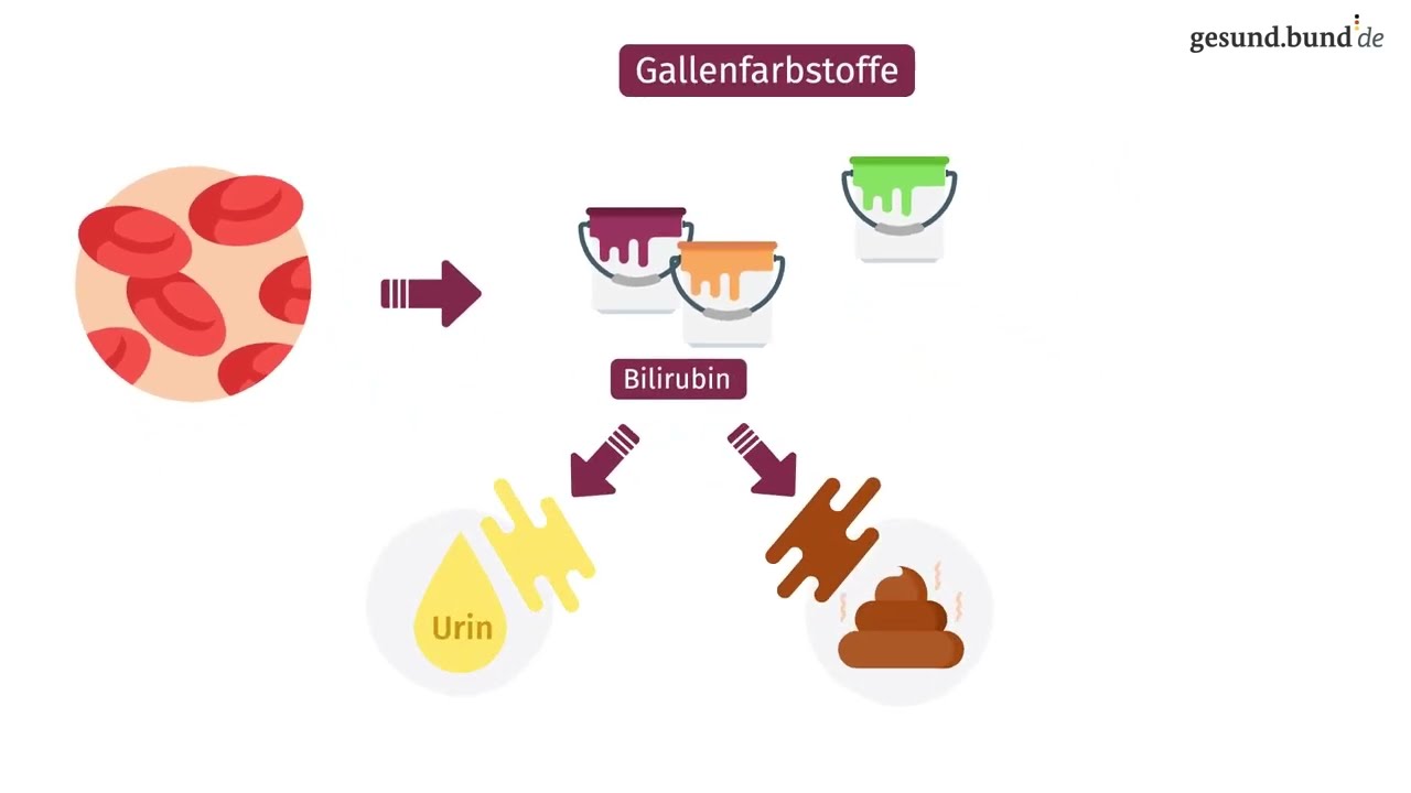 Wie entstehen Gallensteine?