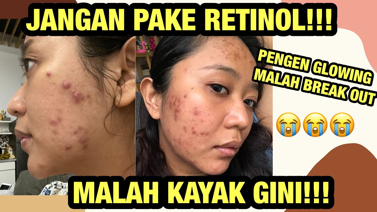 CARA AMAN PAKE RETINOL UNTUK PEMULA (WAJIB TAU SEBELUM PAKE RETINOL)