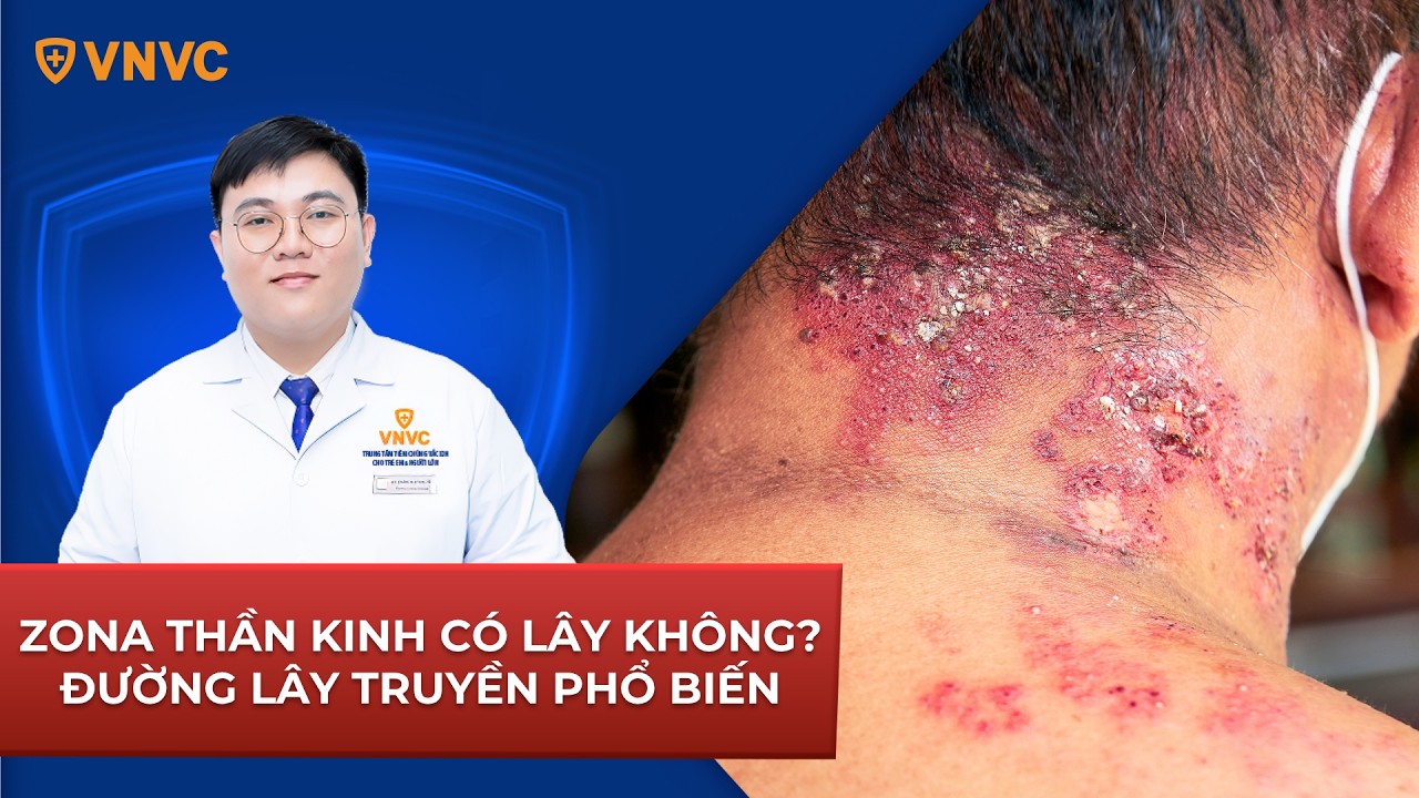Zona thần kinh có lây không? Đường lây truyền phổ biến? | BS Huỳnh Trần An Khương | VNVC
