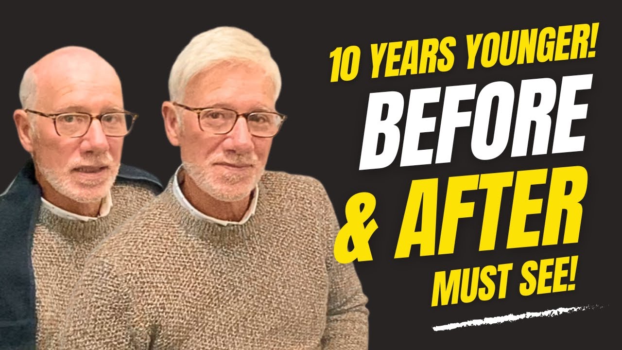 Look 10 Years Younger with a Hair System – The Ultimate Hair System Transformation