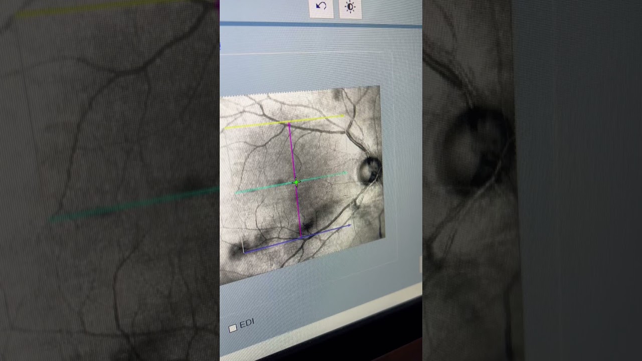 LASIK induced vitreous floaters taken with Optical Coherence Tomography (OCT).