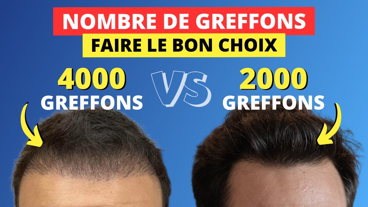 Combien faut il d'implants pour une greffe de cheveux réussie ?