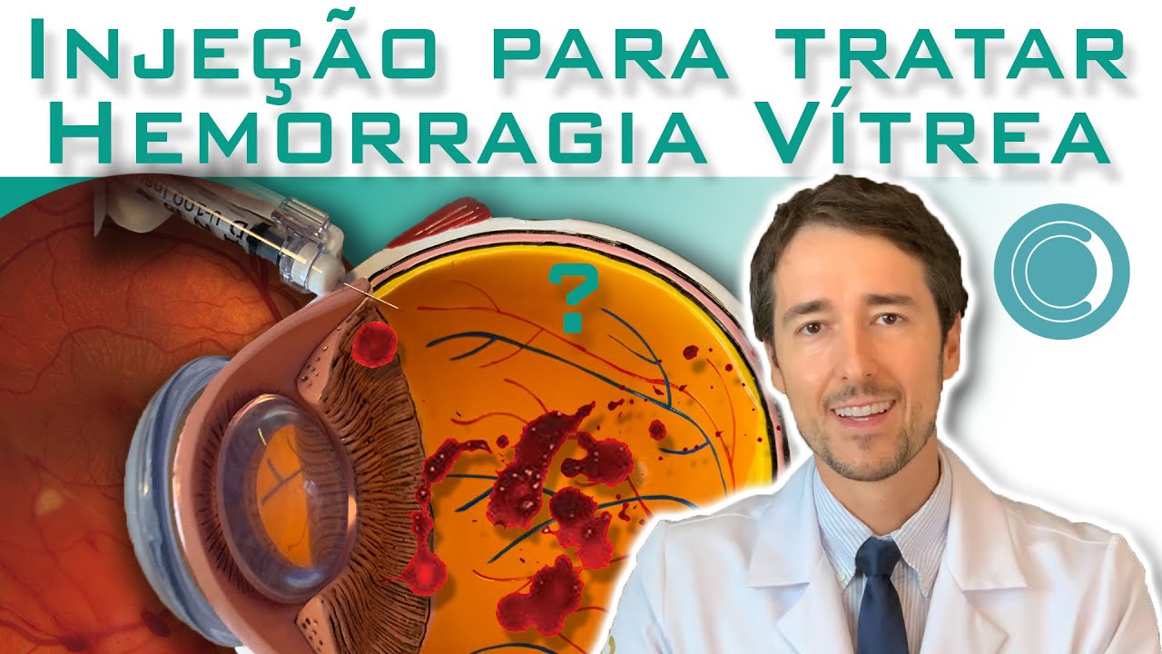 Tratamento da hemorragia vítrea com injeção de antiangiogênico