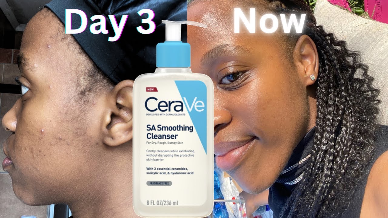AFTER 5 DAYS! Cleared Skin | Honest Review | CeraVe SA Smoothing Cleanser |breakouts & dark spots