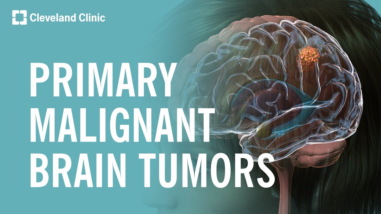 What Are Primary Malignant Brain Tumors?