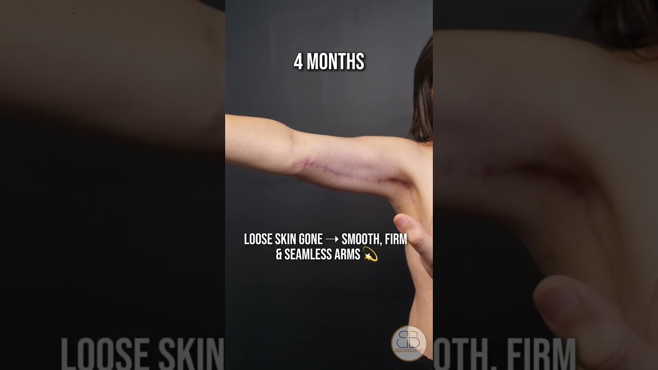 4 Months After Arm Lift + Lipo | Loose Skin Transformation ✨ #beforeandafter 