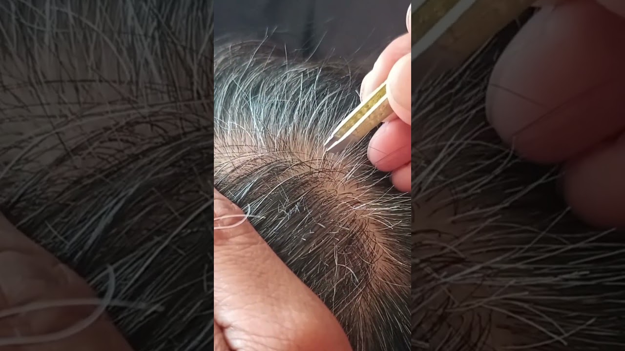 Most satisfying white hair removal#37#musicbackground #satisfying