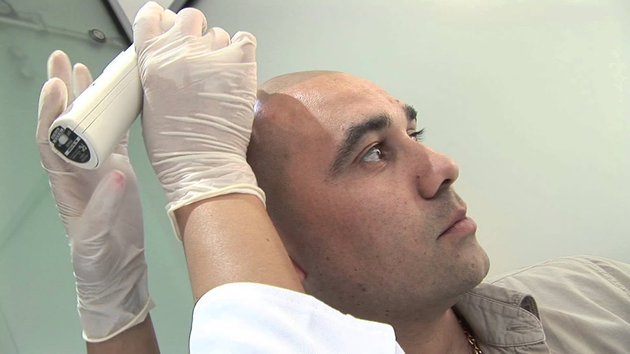 Scalp Micro Pigmentation Harley Street London
