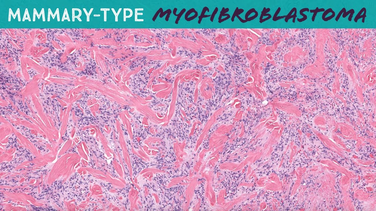 Mammary-type Myofibroblastoma - a relative of spindle cell lipoma! (Yale case 3) pathology dermpath