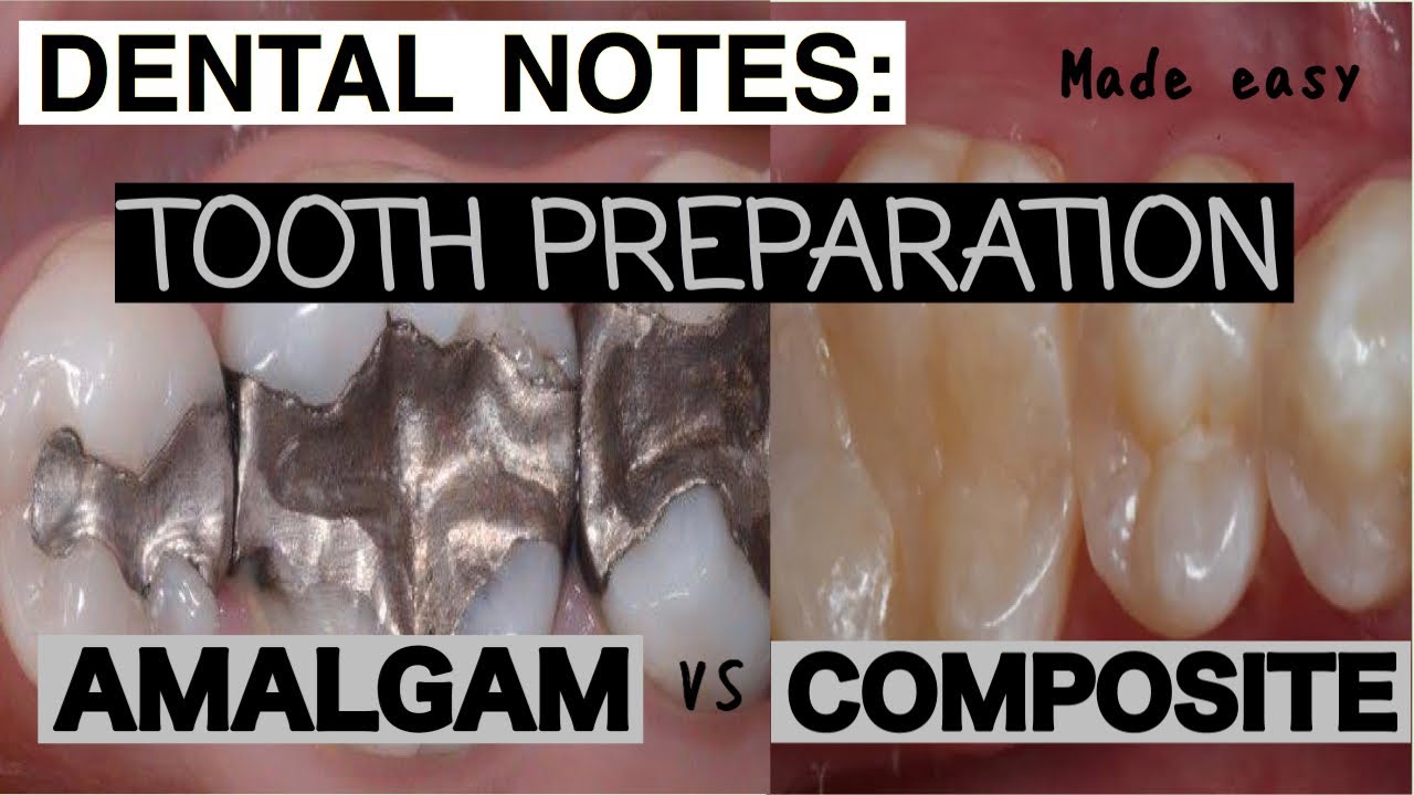 DIFFERENCE BETWEEN AMALGAM AND COMPOSITE TOOTH PREPARATION || CONSERVATIVE DENTISTRY || imp