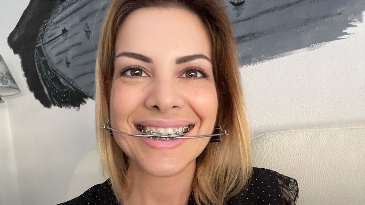 Aggiornamento apparecchio ortodontico dopo 3 anni e 9 mesi ❤️ MyGlamLife