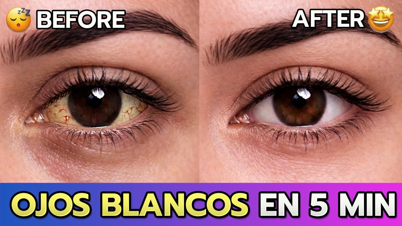 Ojos Blancos en 5 Min 👁️✨ (Sin Gotas) | Adiós Amarillo y Venitas